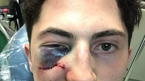 Zach Werenski took a puck to the face in Game 3